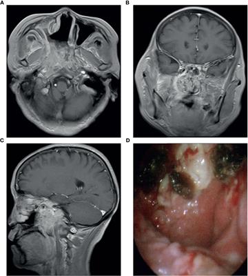 A Short-Term Efficacy of Anlotinib in the Treatment of Refractory Nasopharyngeal Inverted Papilloma: A Case Report